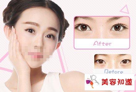 割双眼皮与埋线双眼皮：区别与注意事项