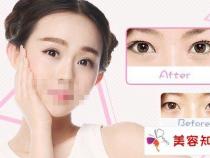 割双眼皮与埋线双眼皮，区别与注意事项