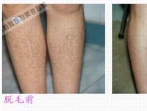 彻底去除腿毛，激光脱毛的原理、效果及注意事项