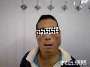 马德龙病：一种难以抑制的疾病与治疗方法